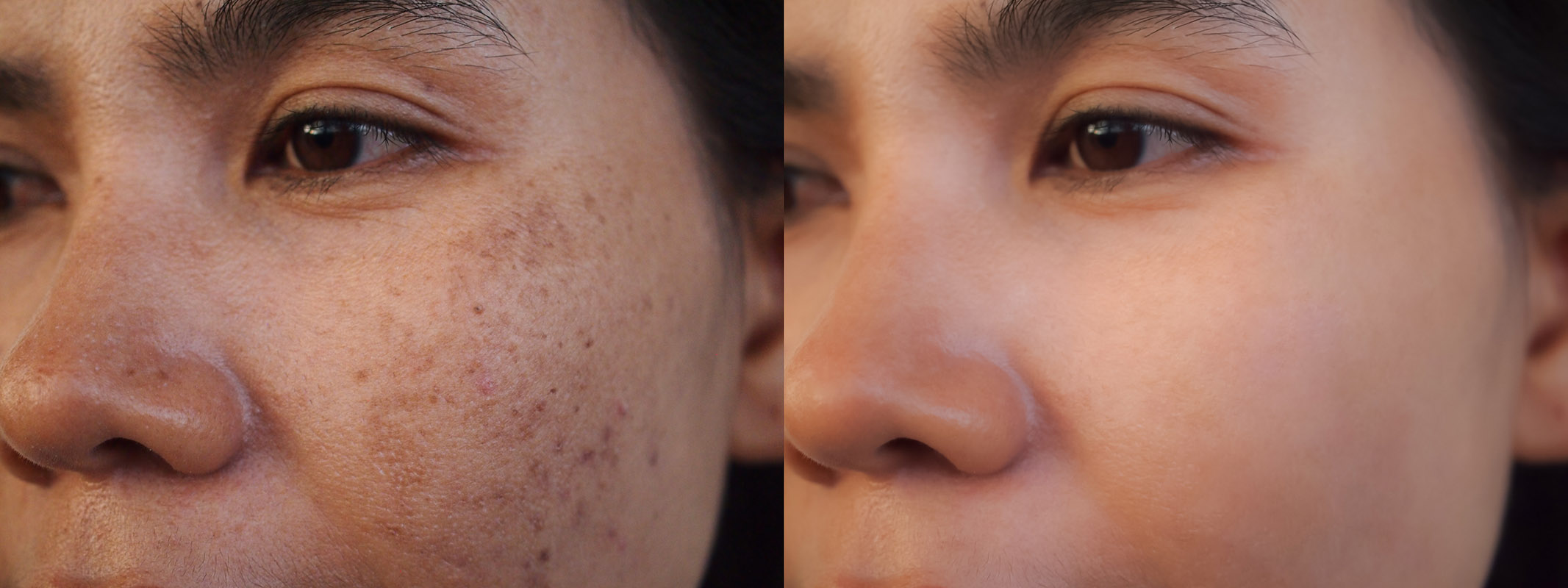 Closeup asian woman before and after dark spot melasma scar acne pigmentation treatment on skin face. Problem skincare and health concept.