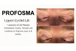 Profosma Upper Eyelid Lift