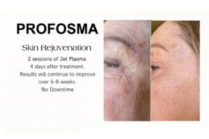 Profosma Skin Rejuvenation