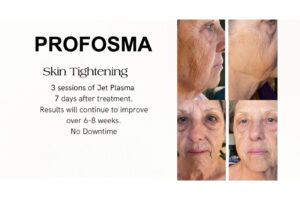 Profosma Skin Tightening