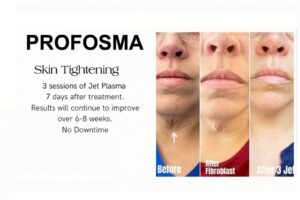 Profosma Skin Tightening
