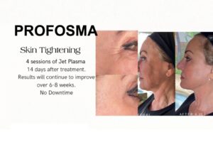 Profosma Skin Tightening