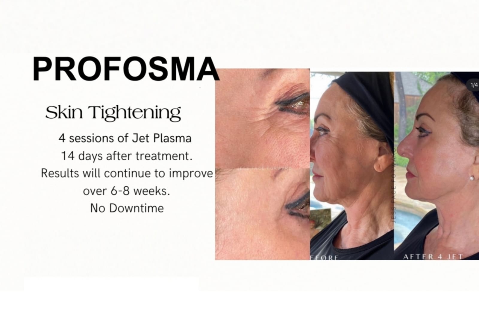 Profosma Skin Tightening