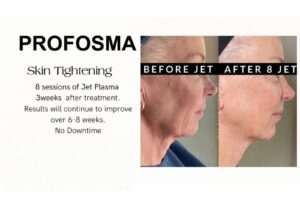 Profosma Skin Tightening