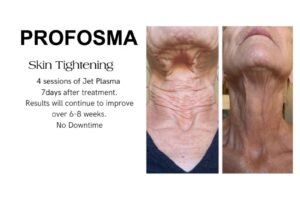 Profosma Skin Tightening