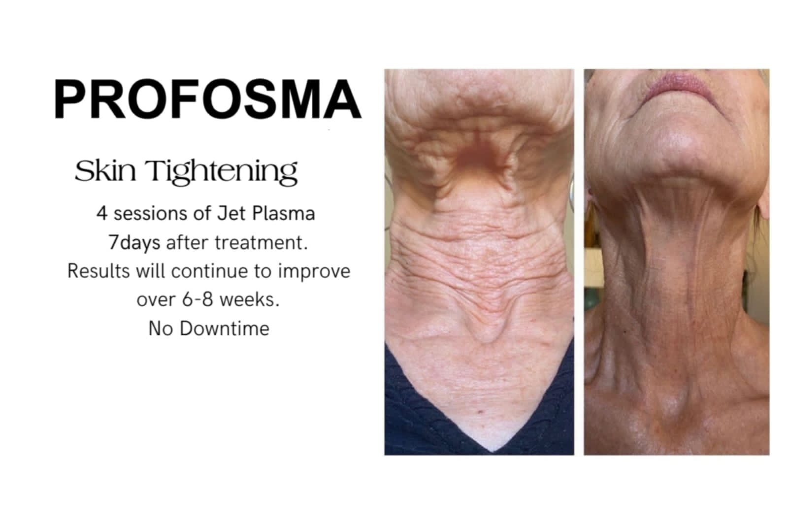 Profosma Skin Tightening