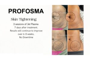 Profosma Skin Tightening