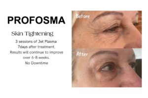 Profosma Skin Tightening