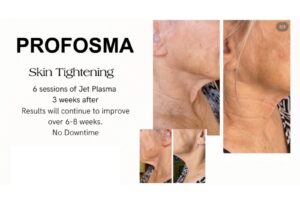 Profosma Skin Tightening