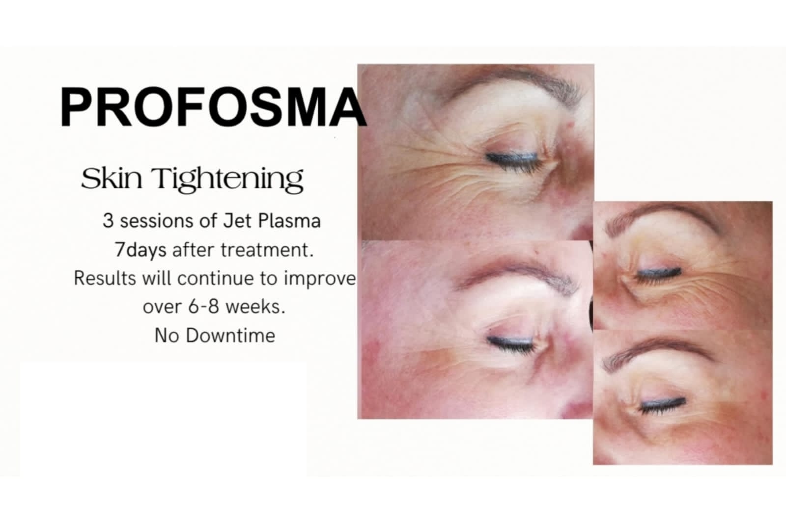 Profosma Skin Tightening