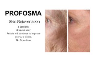 Profosma Skin Rejuvenation