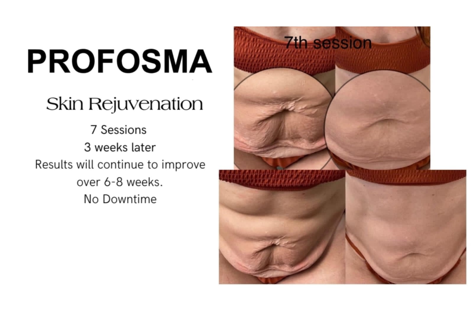 Profosma Skin Rejuvenation