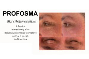 Profosma Skin Rejuvenation