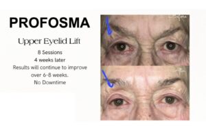 Profosma Upper Eyelid