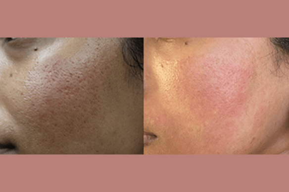 THESERA G BEFORE:AFTER 1