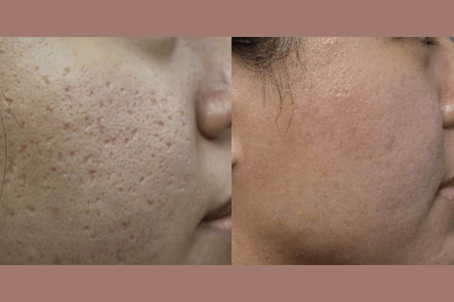 THESERA G BEFORE:AFTER 2