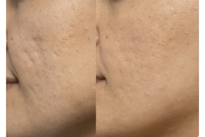 THESERA G BEFORE:AFTER 3